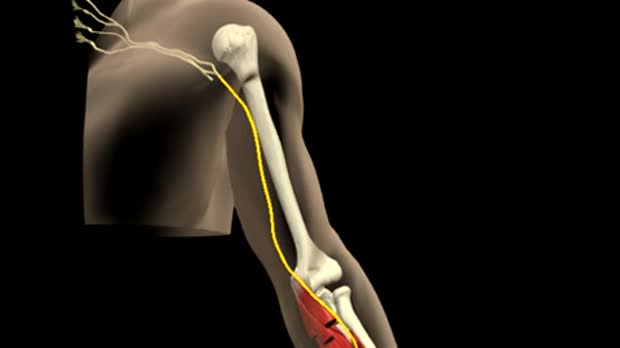 Carpal tunnel syndrome animation