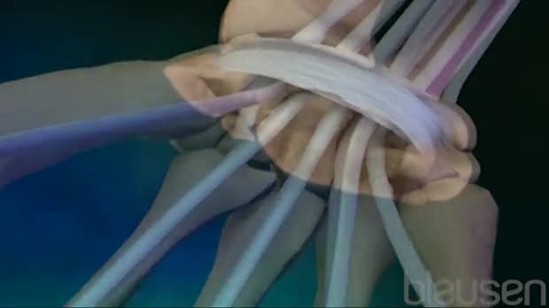 Carpal Tunnel Syndrome