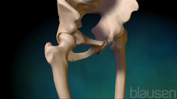 Hip Replacement