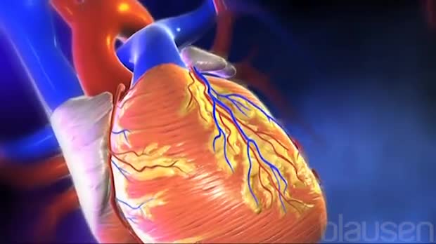 Myocardial Infarction