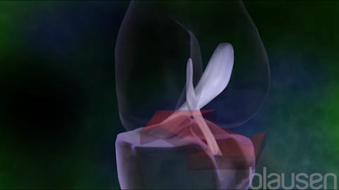 전방 십자 인대 파열